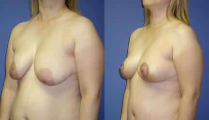 patient-11222-breast-lift-before-after-3