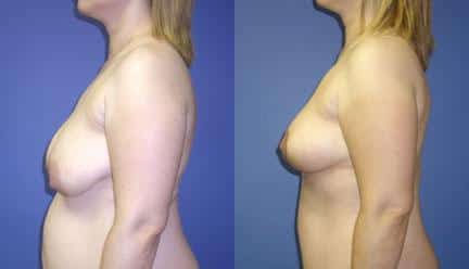 patient-11222-breast-lift-before-after-4