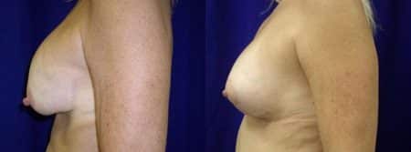 patient-11233-breast-lift-before-after