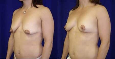 patient-11236-breast-lift-before-after-1