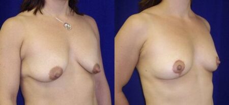 patient-11236-breast-lift-before-after