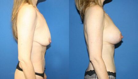 patient-11243-breast-lift-before-after-1