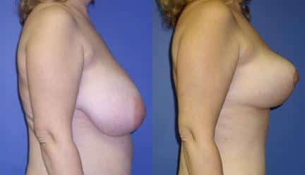 patient-11248-breast-reduction-before-after-1