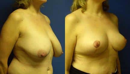 patient-11253-breast-reduction-before-after-1