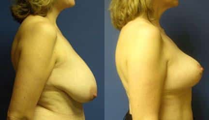 patient-11253-breast-reduction-before-after-2