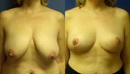 patient-11253-breast-reduction-before-after