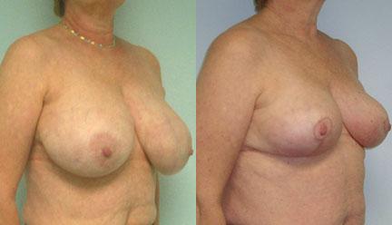 patient-11260-breast-reduction-before-after-1