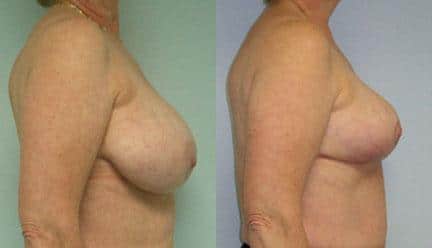 patient-11260-breast-reduction-before-after-2