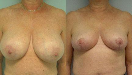 patient-11260-breast-reduction-before-after