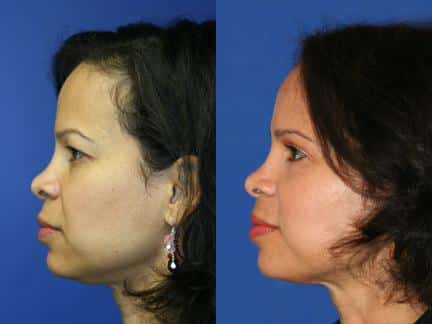 patient-11267-browlift-forehead-lift-before-after-2
