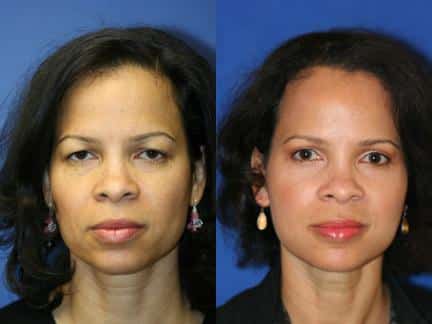 Facelift, blepharoplasty and brow lift to raise brow line and refresh the appearance of a female patient by Dr. Miller. Surgery creates a more awake appearance and smoother forehead for a more youthful look overall.