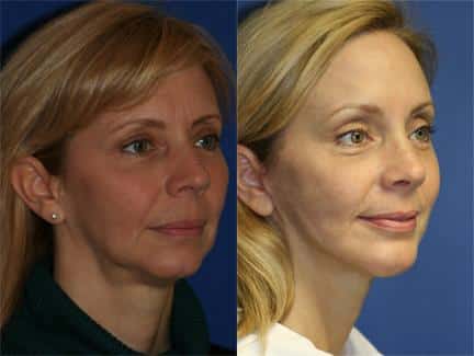 Facelift and brow lift, with laser skin resurfacing, to correct aging symptoms and chin implant to augment the chin of a female patient by Dr. Miller. Surgery creates a refreshed appearance with a more proportionate facial profile..