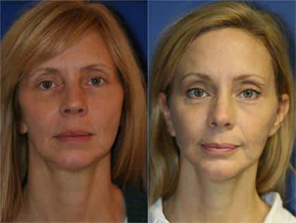 Facelift and brow lift to correct aging symptoms and implant to augment the chin of a female patient by Dr. Miller. After surgery, patient's facial contour is more youthful and balanced..