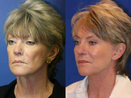 patient-11279-browlift-forehead-lift-before-after-1