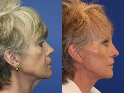 patient-11279-browlift-forehead-lift-before-after-2