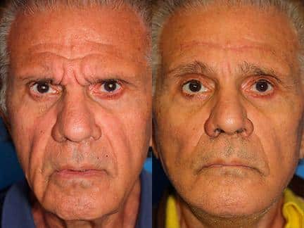 Facelift and brow lift to address sagging skin and the aging symptoms of a male patient by Dr. Miller. Surgery adds definition to the jawline, diminishes facial creases, and reduces hooding above the eyes.
