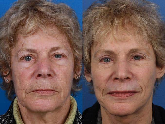 Facelift and neck lift to address skin laxity and restore definition to the lower face and neck of a female patient by Dr. Miller. Surgery removes jowl formation and significantly reduces facial creases for a more youthful appearance.