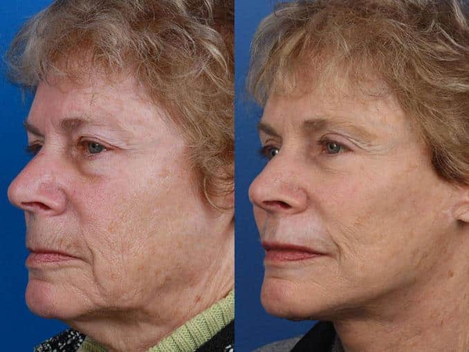 Facelift and neck lift to address skin laxity and restore definition to the lower face and neck of a female patient by Dr. Miller. After surgery, there is a smoother transition from the chin to the neck with a visible reduction in facial creases.