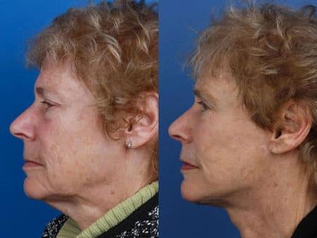 patient-11296-facelift-before-after-5