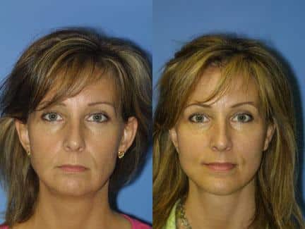 Facelift and neck lift to address skin laxity and restore definition to the lower face and neck of a female patient by Dr. Miller. Surgery reduces jowl formation to create a more youthful contour.
