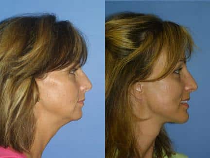 patient-11308-facelift-before-after-4