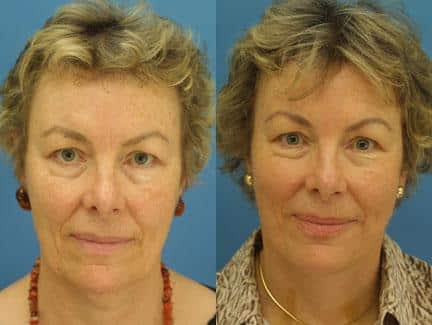 Facelift and neck lift to remove loose skin from the lower face and the neck of a female patient by Dr. Miller. Surgery creates lifted, more youthful facial contour with less skin laxity and fewer wrinkles.