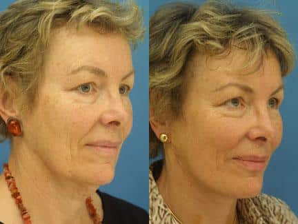 patient-11315-facelift-before-after-4