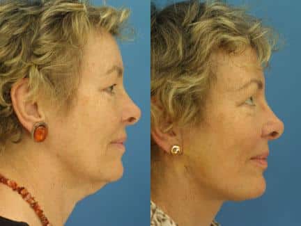 patient-11315-facelift-before-after-5