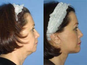 Two images comparing face of an older woman before and after facelift. Face looks much younger with no sagging or loose skin after the treatment, New York, NY