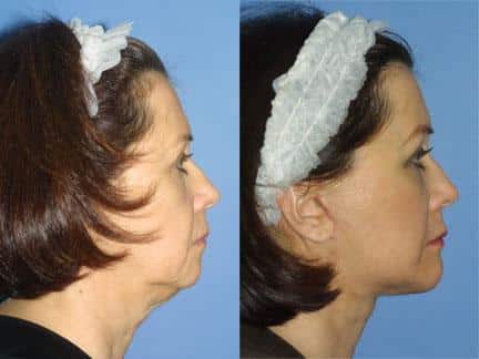 patient-11322-facelift-before-after-4