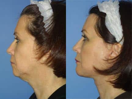 patient-11322-facelift-before-after-5