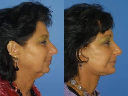 patient-11329-facelift-before-after-3