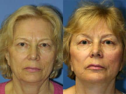 Facelift to add lift and definition to the mid and lower face of a female patient by Dr. Miller. This treatment adds definition to the cheekbones while reducing the appearance of jowls.