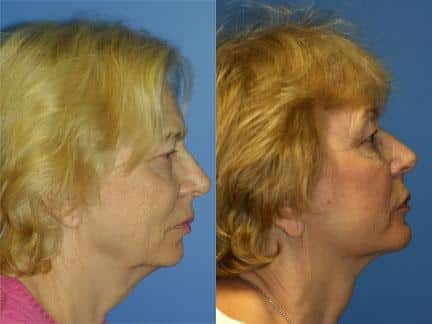 patient-11334-facelift-before-after-4