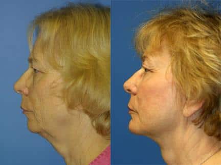 patient-11334-facelift-before-after-5
