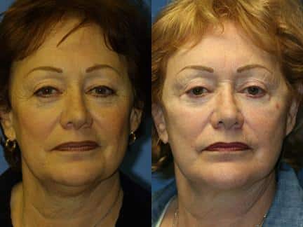 Facelift and neck lift to address skin laxity and restore definition to the lower face and neck of a female patient by Dr. Miller. Surgery creates greater definition along the jawline, smooths the neck, and visibly reduces the appearance of wrinkles.