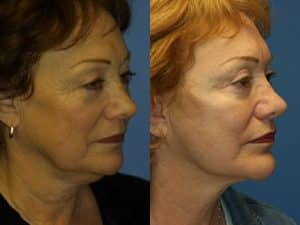 Facelift and neck lift to address skin laxity and restore definition to the lower face and neck of a female patient by Dr. Miller. After surgery, transition from jawline to the neck is smoother and more defined.