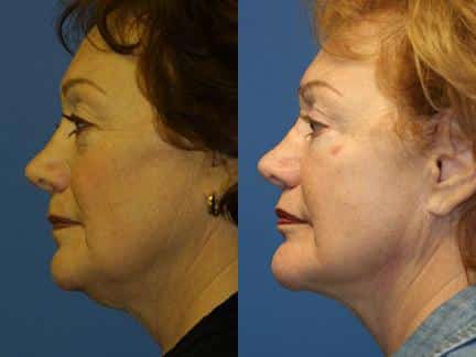 patient-11341-facelift-before-after-5