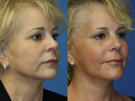 Facelift to add lift and definition to the mid and lower face of a female patient by Dr. Miller. Surgery improves jawline, reduces early jowl formation and facial wrinkles.