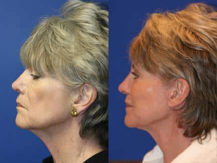 Facelift, brow lift, blepharoplasty, laser skin resurfacing, and fat injections to improve the facial profile of a female patient by Dr. Miller. Surgery improves definition to the jawline and reduces wrinkles for a more youthful appearance.