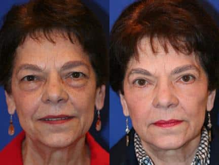 Facelift to add lift and definition to the mid and lower face of a female patient by Dr. Miller. Surgery reduces jowl formation along the jawline and minimizes the appearance of facial creases.