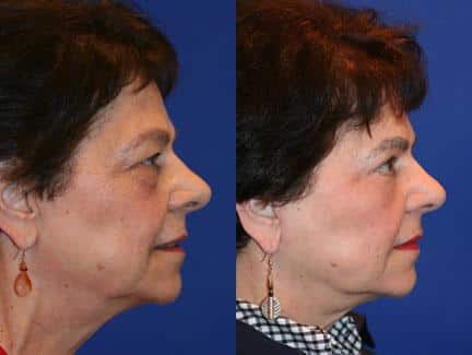 patient-11367-facelift-before-after-5