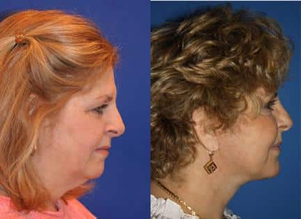 Facelift and neck lift to address skin laxity and restore definition to the lower face and neck of a female patient by Dr. Miller. Surgery creates smoother contour from chin to neck.
