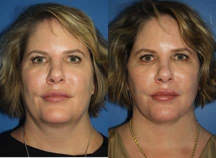 Facelift to add lift and definition to the mid and lower face of a female patient by Dr. Miller. Procedure lifts mid-face to add definition to cheekbones while creating a smoother contour t the jawline.