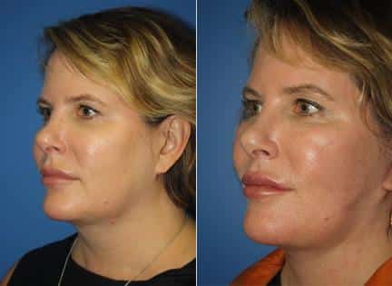 patient-11381-facelift-before-after-3