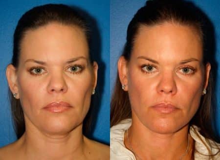 patient-11389-facelift-before-after-2