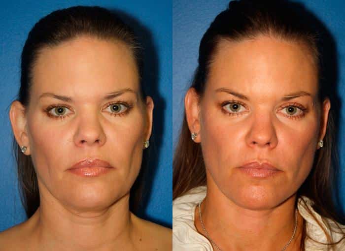 Facelift to add lift and definition to the mid and lower face of a female patient by Dr. Miller. After surgery, patient's facial contour is lifted with a reduction in jowl formation and a more youthful mid-face.