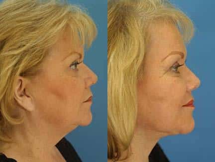 Facelift and neck lift to address skin laxity and restore definition to the lower face and neck of a female patient by Dr. Miller. Jawline is more defined with a smoother transition from the chin to the neck after surgery.