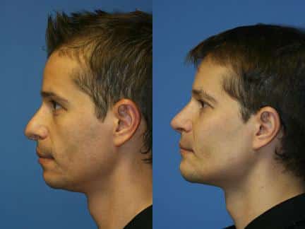 jawline surgery to correct weak jawline on a male patient