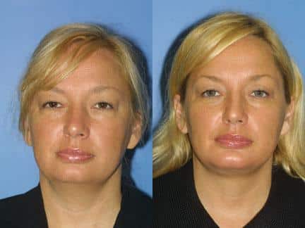 Facelift and blepharoplasty to correct aging symptoms, and neck liposuction and chin implant to enhance the jawline of a female patient by Dr. Miller. Surgery creates a more youthful facial contour with a stronger, more defined jawline.